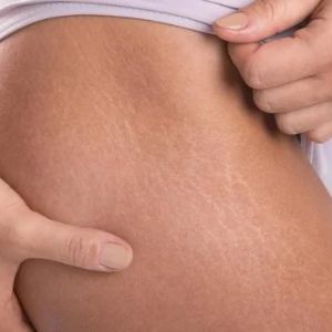 Stretch Mark Removal Treatment in Trivandrum