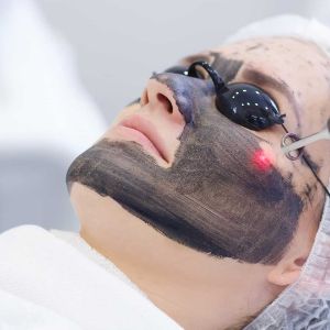 Carbon Laser Peel in Trivandrum