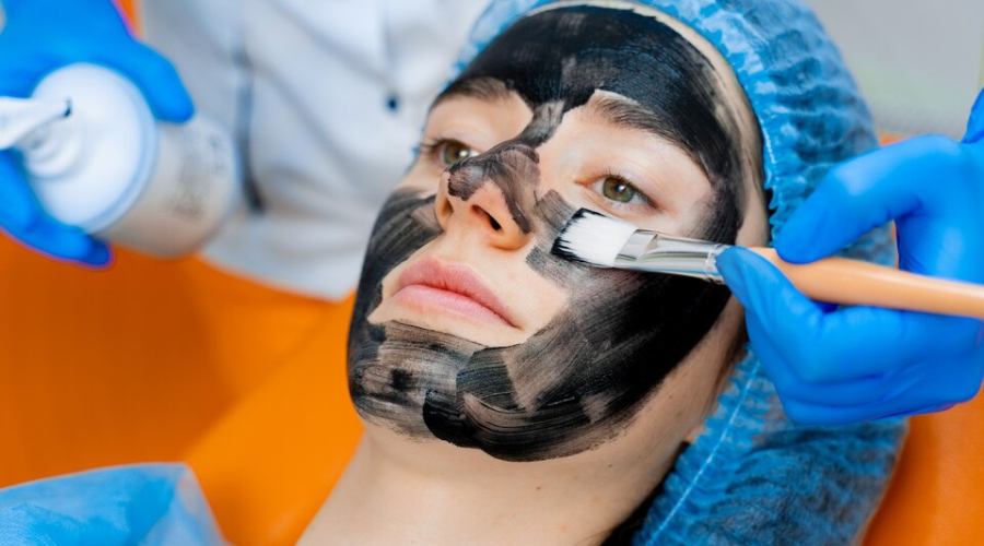 Carbon Laser Peel